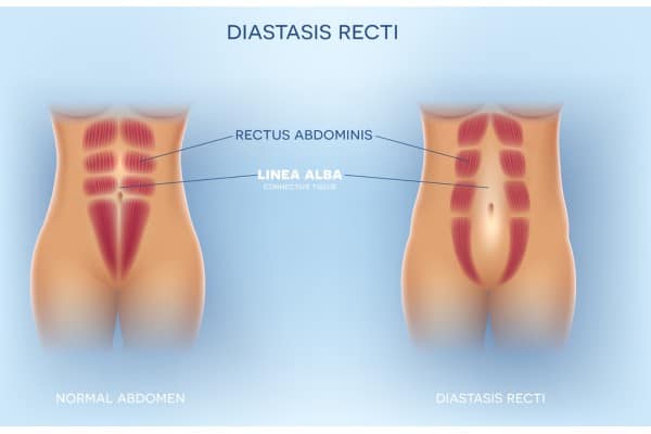 What Non-Surgical Options Are Available for Diastasis Recti Redditch?