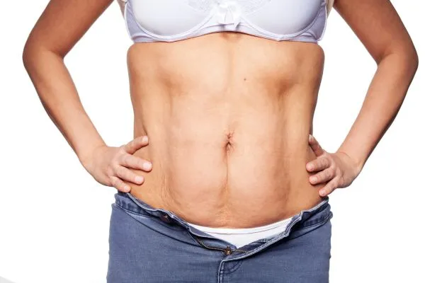 sagging skin on woman's stomach after weight loss injections Redditch