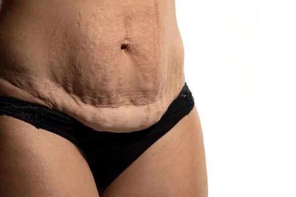 Image of womans stomach after weight loss injections Redditch showing saggy skin